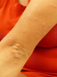 Why Mosquitoes Think You Are Extra Tasty & What You Can Do About It